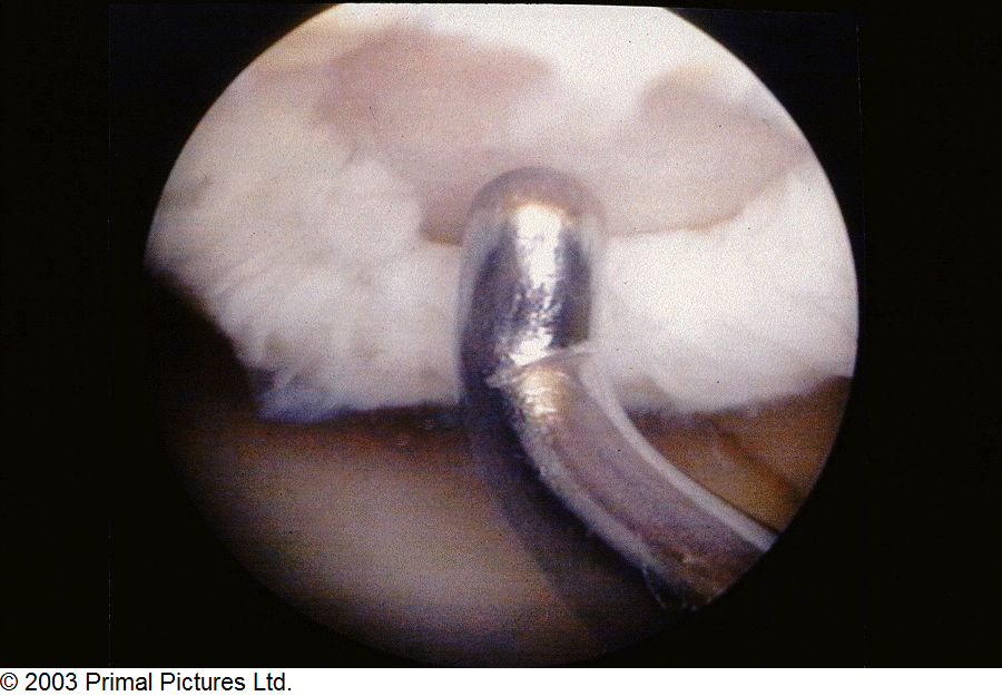 Grade 4 Chondromalacia Knee Treatment