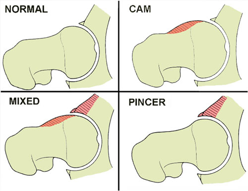 Cam Lesion Brian Schiff’s Blog