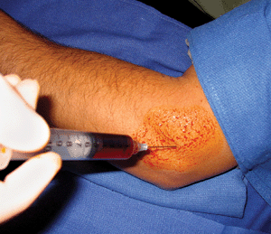 clinical-prp-injection