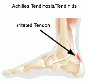 achillestendonitis