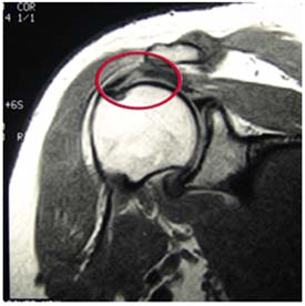 mri-full-thickness-rc-tear