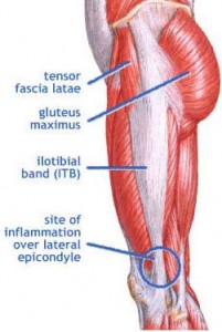 iliotibial-band-syndrome